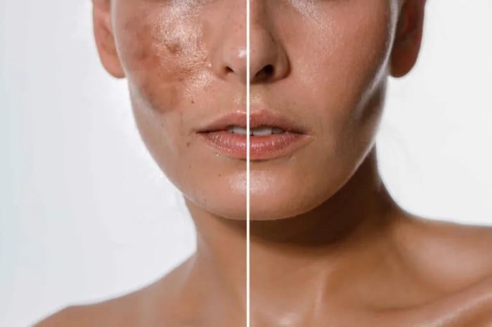 Skin rejuvenation